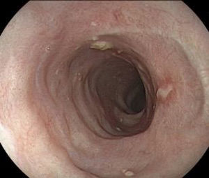Control endoscópico en 90 días, sin estenosis o lesión residual luego de terapia con corticoides.