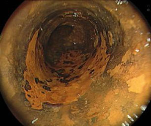 Cromoendoscopia con lugol.