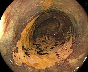 Cromoendoscopia signo del color salmón luego de 3 min.