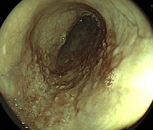 Cromoendoscopia digital: FICE.