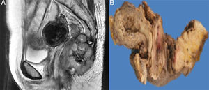 RMN abdómino-pélvica. A) Neo formación dependiente del recto inferior con extensión a región anal que involucra músculos del periné, y ambos glúteos. B) Corte sagital espécimen quirúrgico.