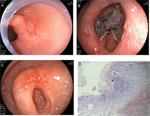 Disección endoscópica submucosa (DES) de lesión prepilórica. En A) se aprecia lesión ligeramente deprimida con bordes elevados de 2cm, de bordes mal definidos, superficie irregular. En B) se aprecia el resultado final de la disección submucosa. En C) se aprecia la cicatriz de la DES 8 semanas luego del procedimiento. La figura D) demuestra adenocarcinoma bien diferenciado intramucoso, con bordes quirúrgicos libres.