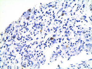 Biopsia de intestino con marcador para CMV+, en la que se observan múltiples células con marcador intracelular positivo.