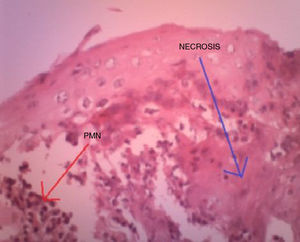 Permeación de PMN neutrófilos y áreas de epitelio necrosado.