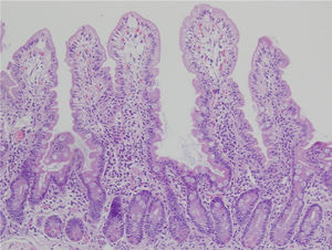 Biopsia duodenal para análisis histológico de la EC. Las alteraciones histológicas deben evaluarse en biopsias bien orientadas y se deben identificar al menos 4 vellosidades que deben tener la morfología observada en la microfotografía. La descripción debe incluir: a) morfología de las vellosidades, si la atrofia está presente o no, si la atrofia es parcial, subtotal o total; b) contenido celular en la lámina propia (linfocitos, células plasmáticas, eosinófilos o neutrófilos); c) presencia de glándulas de Brunner e hiperplasia de las criptas; y d) número de linfocitos intraepiteliales considerando normal menos de 25 linfocitos/100 enterocitos.