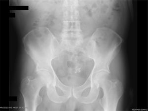 Radiografía simple de abdomen con prótesis dental en sigmoides.