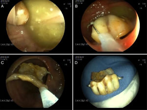 A) Prótesis dental impactada en divertículo. B) Extracción de prótesis con asa. C) Paso de prótesis a través de anastomosis. D) Prótesis dental extraída.
