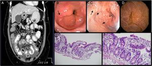 A) Ascitis, engrosamiento difuso y concéntrico de intestino delgado. B,C)EDS con cambios sugestivos de esofagitis eosinofílica y duodenitis. D)Cápsula endoscópica: mucosa con edema, eritema que produce engrosamiento de vellosidades. E)Íleon (H&E, 100×). Mucosa ileal conservada con vellosidades ligeramente ensanchadas y aplanadas con infiltrado inflamatorio linfocitario, presencia de mayor número de eosinófilos y criptas con algunas ramificaciones. F)Íleon (H&E, 400×). Mucosa ileal con mayor aumento donde se observan linfocitos y eosinófilos en mayor proporción de lo usual en la lámina propia, los cuales hacen exocitosis al epitelio superficial y a las criptas.