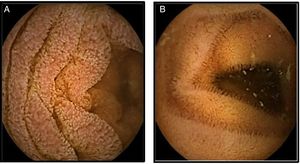 Cápsula endoscópica. A)Mucosa con edema, eritema que produce engrosamiento de vellosidades. B)Control con desaparición del edema y eritema con normalización del grosor de las vellosidades.