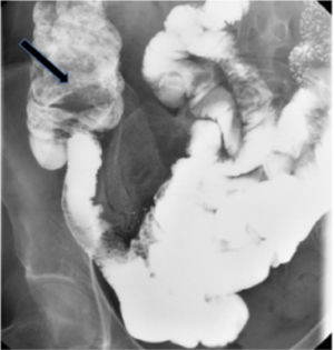 Tránsito intestinal: defecto de repleción en el ciego sugestivo de la existencia de una tumoración (flecha negra).