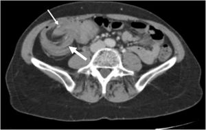 TAC abdominal en corte axial: invaginación del íleon (flecha delgada) en el colon transverso (flecha gruesa). Imagen «en diana».