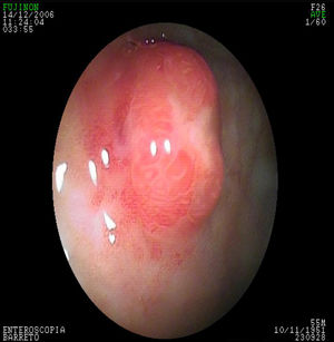 Tumor neuroendocrino gástrico ulcerado.