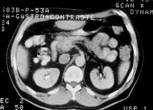 Tumor carcinoide pancreático en proceso uncinado por tomografía axial computarizada (TAC).