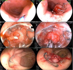 A) Pequeña fistula esofagotraqueal, paso de guía por la fistula para adecuado reconocimiento de la misma. B) Clip Ovesco liberado en sitio de fístula con cierre completo. C) Perforación en hernia hiatal durante el paso de sonda nasogástrica. D) Uso de pinza Twin Grasper®: momento del afrontamiento para posterior liberación del dispositivo. E) Dehiscencia de sutura de parche de Graham en estómago (pared anterior de antro proximal). F) Cierre con clip Ovesco del orificio fistuloso.