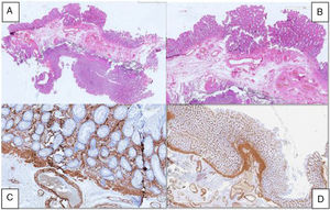 Análisis anatomopatológico del espécimen. A) Vista panorámica del espécimen. B) Infiltración crónica inflamatoria y engrosamiento de mucosa. C) Anormalidades glandulares. D) Engrosamiento de la mucosa muscularis.