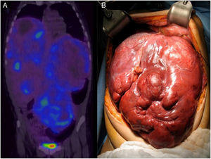 A) SPECT/CT abdominal con octreótido que muestra captación en la gran tumoración hepática. B) Vista del abdomen de la paciente al inicio del trasplante donde se observa la infiltración masiva del hígado.