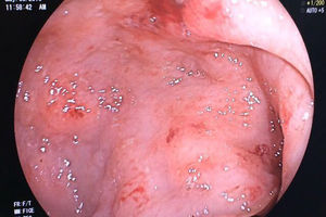 Endoscopia alta: lesión ulcerada con zonas hiperémicas localizada en el cuerpo gástrico.