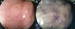 a) Magnificación de lesión polipoidea localizada en el colon sigmoides, donde se observa un patrón glandular tubular corto. b) Cromoendoscopia digital de lesión polipoidea localizada en el colon sigmoides, donde se observa un patrón vascular regular.