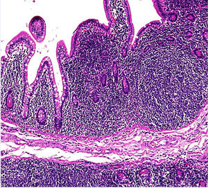 Microfotografía de linfoma del manto afectando mucosa intestinal. Se observa una proliferación nodular de linfocitos pequeños y hendidos que originan una configuración polipoidea de la mucosa (hematoxilina y eosina, 40×).