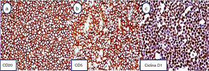 Inmunofenotipo del linfoma del manto. Las células neoplásicas demostraron positividad membranaria para CD20 (a) y para CD5 (b), lo que confirma la estirpe de linfocito B neoplásico. Además, las células demostraron marcación nuclear para ciclina D1 (c) (inmunohistoquímica, 100×).