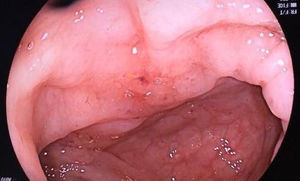 Endoscopia alta: presencia de pliegues engrosados en la incisura angularis.