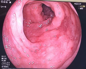 Colonoscopia: lesiones polipoideas localizadas en el colon sigmoides.