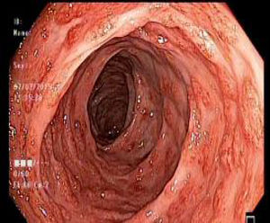 Colonoscopia: lesiones polipoides confluentes con zonas hiperémicas localizadas en el colon descendente.