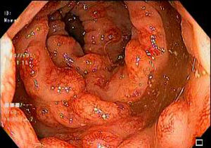 Colonoscopia: lesiones polipoides confluentes, con zonas hiperémicas y pliegues engrosados localizadas en el colon descendente.