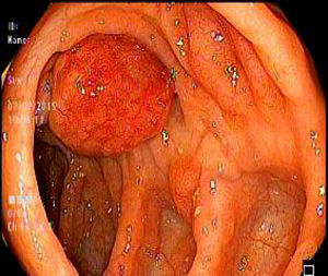 Colonoscopia: lesión polipoidea en el colon ascendente.