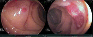 Angiectasia, esclerosis con argón plasma.