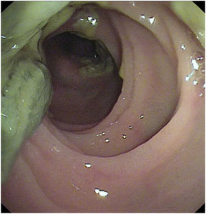 Meconio en intestino delgado en paciente postrasplante pulmonar desobstruido por enteroscopia de doble balón.