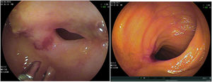 Úlcera y estenosis por Crohn y úlceras inflamatorias por AINE.
