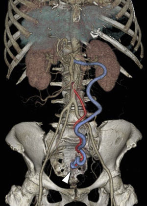 TCMA coronal de reconstrucción por volumetría muestra la FAV AMI-VMI compuesta por una AMI hipertrófica (rojo) con FAV (punta de flecha) en su tercio distal (región pélvica) y una VMI dilatada (azul).
