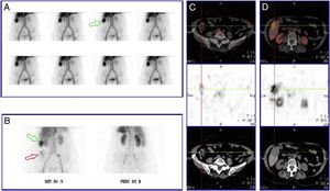 Gammagrafía con hematíes marcados con 99mTc-pirofosfato de estaño, imágenes dinámicas durante una hora: distribución fisiológica del trazador, sin evidencia de focos hemorrágicos. Área hipercaptante de morfología nodular en hipocondrio derecho (flecha verde) (A). Imágenes tardías a las 24h postinyección: persiste área de hipercaptación a nivel del hipocondrio derecho (flecha verde). Captación de nueva aparición, baja intensidad y carácter difuso en fosa ilíaca derecha (flecha roja) (B). Modalidad SPECT/CT abdominal a las 24h postinyección: captación endoluminal del trazador en extremo distal del colon ascendente, que aumenta su actividad en el tiempo, compatible con hemorragia de bajo débito (C). Imagen nodular hipercaptante en segmento V hepático indicativo de estructura vascular fija (hemangioma) (D).