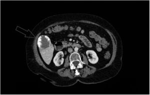 TC de abdomen con contraste iv en corte axial: lesión focal con captación nodular periférica (de aproximadamente 5,1×4,6cm) localizada en segmento V hepático compatible con hemangioma exofítico.
