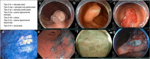 Ejemplo representativos de diversas lesiones neoplásicas superficiales o incipientes tipo 0. a) Lesión tipo 0-is (elevada sésil). b) Lesión tipo 0-isp (elevada subpediculada). c) Lesión tipo 0-ip (elevada pediculada). d) Lesión tipo 0-iia (plana ligeramente elevada). e) Lesión tipo 0-iib (plana). f) Lesión tipo 0-iic (plana ligeramente excavada). g) Lesión tipo 0-iii (no polipoide y excavada). Imágenes cortesía Dr. Miguel Ángel Tanimoto Licona.