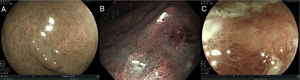Ejemplos de lesiones gástricas utilizando tecnologías de imagen endoscópica mejorada que evalúa las características de la mucosa y los microcapilares. a) Patrón mucoso regular. b) Patrón mucoso irregular. c) Patrón mucoso aberrante o ausente. Imágenes cortesía Dr. Miguel Ángel Tanimoto Licona.
