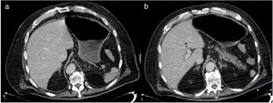 a) TAC con estómago sin evidencia de engrosamientos anormales, y se observa resolución de la neumatosis; b) Disminución de gas portal con presencia de trombo en rama izquierda.