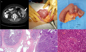 A) Tomografía computarizada con engrosamiento de yeyuno proximal, el cual condiciona oclusión parcial intestinal. B y C) Resección de yeyuno con linfadenectomía mesentérica regional. D y E) Tumor epitelial maligno dispuesto en nidos y en patrón cribiforme, correspondiente a adenocarcinoma moderadamente diferenciado sin infiltración de serosa.