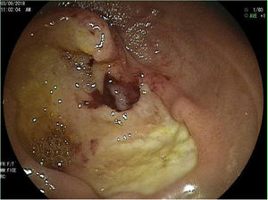 Estenosis ulcerada prácticamente completa de la 3.ª porción duodenal.