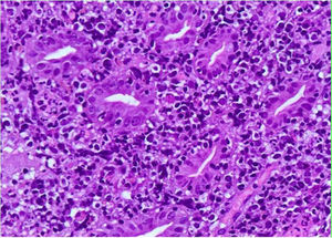 Infiltraci6n de la mucosa duodenal por células grandes de estirpe linfoide.