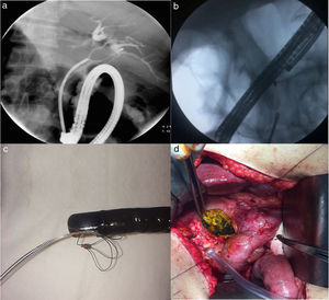 A) Una imagen de colangiografía muestra un cálculo capturado con la canastilla de extracción de cálculos© con situs inversus totalis (caso 1). B) Una imagen de colangiografía muestra los fórceps de recuperación utilizados para retirar la canastilla de extracción de cálculos biliares (caso 2). C) Fotografía de la canastilla de extracción de cálculos biliares después de retirarla del paciente (caso 2). D) Fotografía de la cirugía en un paciente con una canastilla de extracción de cálculos biliares impactada.
