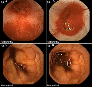 Hombre de 52 años consumidor crónico de diclofenaco. A-B) Imagen de cápsula endoscópica que demuestra inicialmente hemorragia activa en yeyuno. C-D) Posteriormente se evidencia la presencia de úlceras cubiertas de fibrina de forma circunferencial. Imágenes originales: Dr. José María Remes Troche.