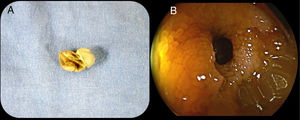 A. Cápsula patency deformada posterior al paso por la estenosis y evacuación. B. Estenosis intestinal observada por enteroscopia.