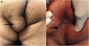 A) Tumor bien definido de 6×6cm en el glúteo izquierdo y el perineo. La flecha negra apunta hacia el orificio externo de la fístula perianal. B) La herida perianal fue sanada por intención secundaria en el seguimiento a 12 meses. La flecha negra apunta hacia la cicatriz del orificio externo de la fístula completamente sanada.