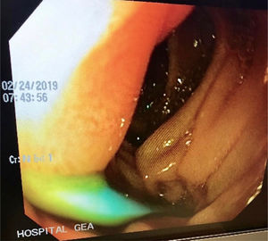 Imagen de panendoscopia corroborando el sitio de migración y perforación de la endoprótesis.