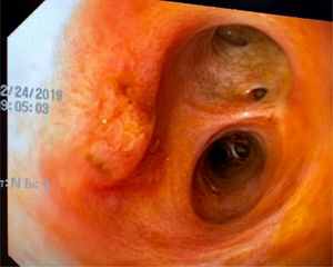 Coledocoscopia transoperatoria, con ausencia de litiasis residual o estenosis, lo cual permitió el cierre primario del colédoco sin prótesis ni sonda en T.