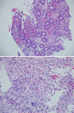 A) H & E en 200x: muestra duodeno: inflamación crónica activa. B) Imagen en 400x. Úlcera con marcado infiltrado linfoplasmocitario, sin evidencia de malignidad.