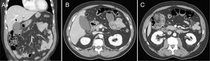 A. Corte coronal, presencia de cambios inflamatorios pericolecísticos (punta de flecha) y un flemón pericólico (flecha). B. Corte axial, cambios inflamatorios perivesiculares, estriación de la grasa a este nivel, datos que pudieran indicar un cuadro de colecistitis aguda. C. Corte axial, engrosamiento de la pared del colon del ángulo hepático y estriación de grasa pericolónica, con enfermedad diverticular activa.