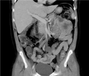 Corte coronal de la TC abdominal donde se aprecia masa mamelonada en el hipocondrio izquierdo.